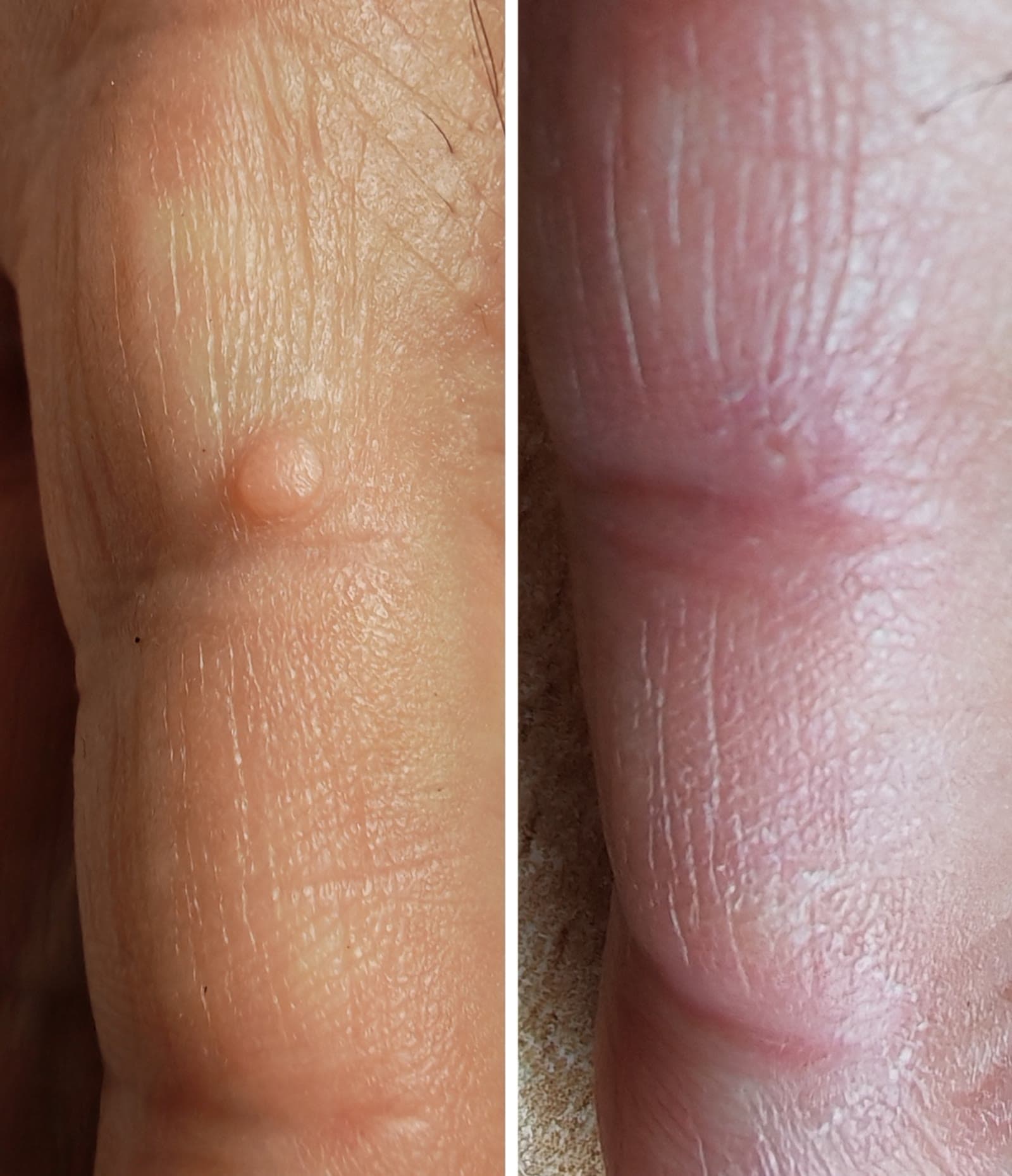 Tratamiento con láser de plasma para eliminar una marca cutánea