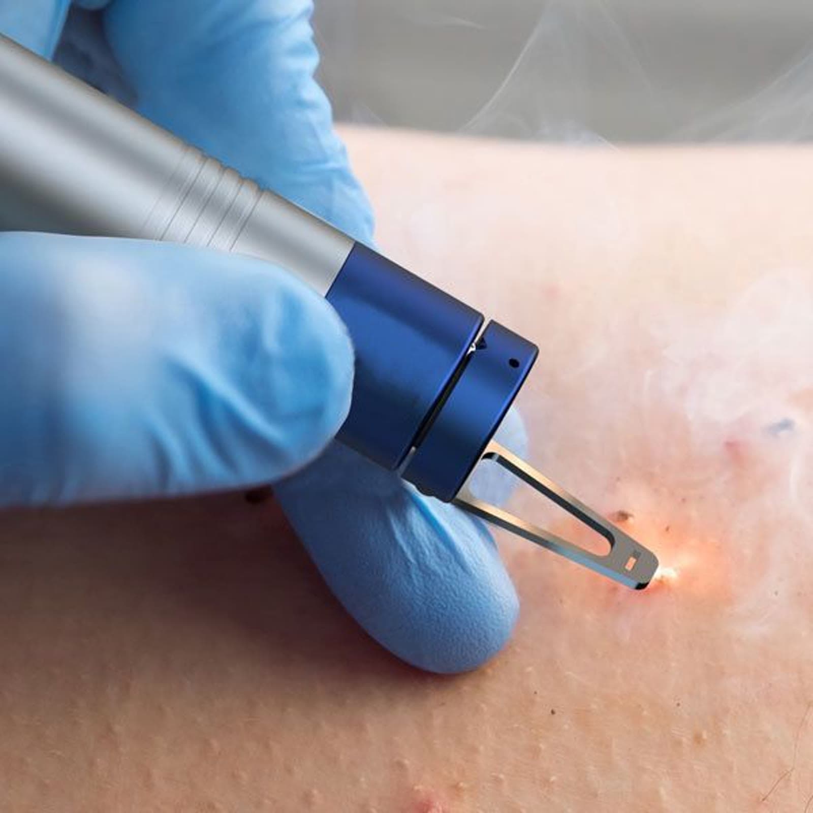 Tratamiento con láser de plasma para eliminar una marca cutánea